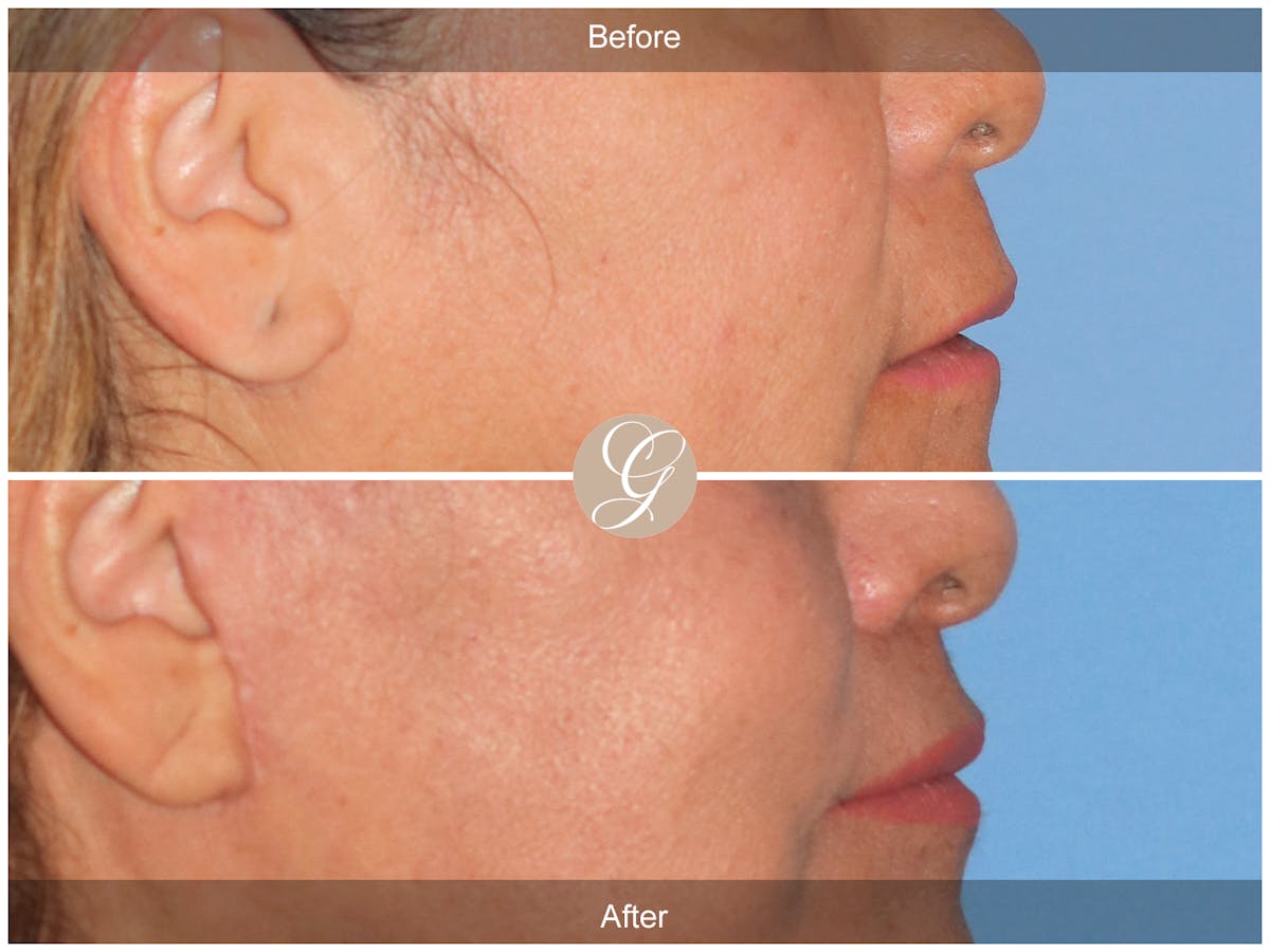 Lip Lift Before & After Gallery - Patient 381653 - Image 2