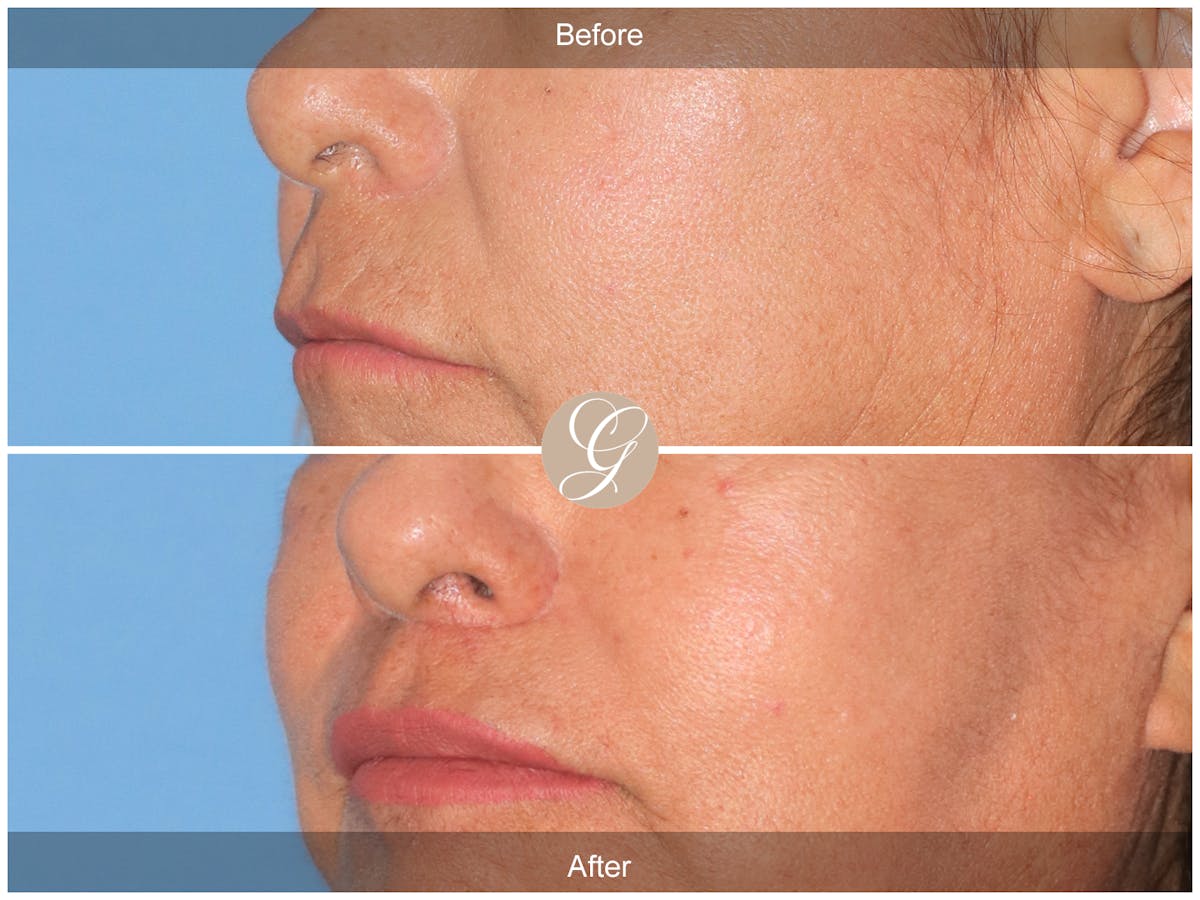 Lip Lift Before & After Gallery - Patient 381653 - Image 3