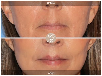 Lip Lift Before & After Gallery - Patient 218876 - Image 1