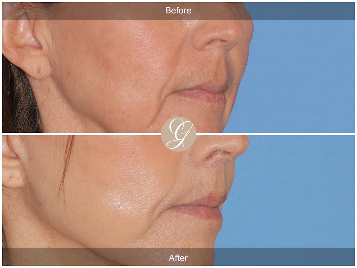 Lip Lift Before & After Gallery - Patient 218876 - Image 2