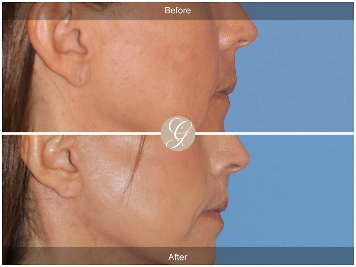 Lip Lift Before & After Gallery - Patient 218876 - Image 3