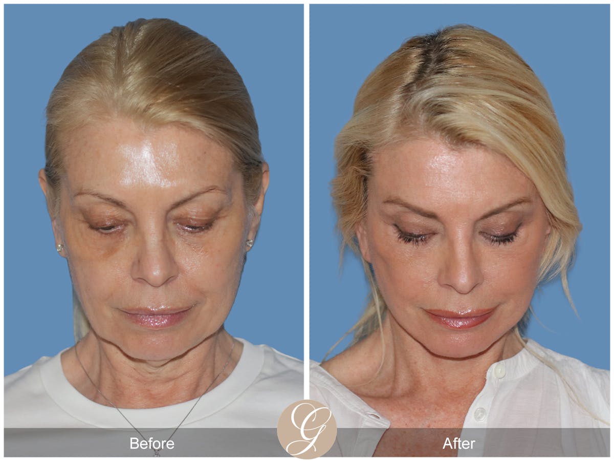 Preservation Facelift Before & After Gallery - Patient 306280 - Image 2