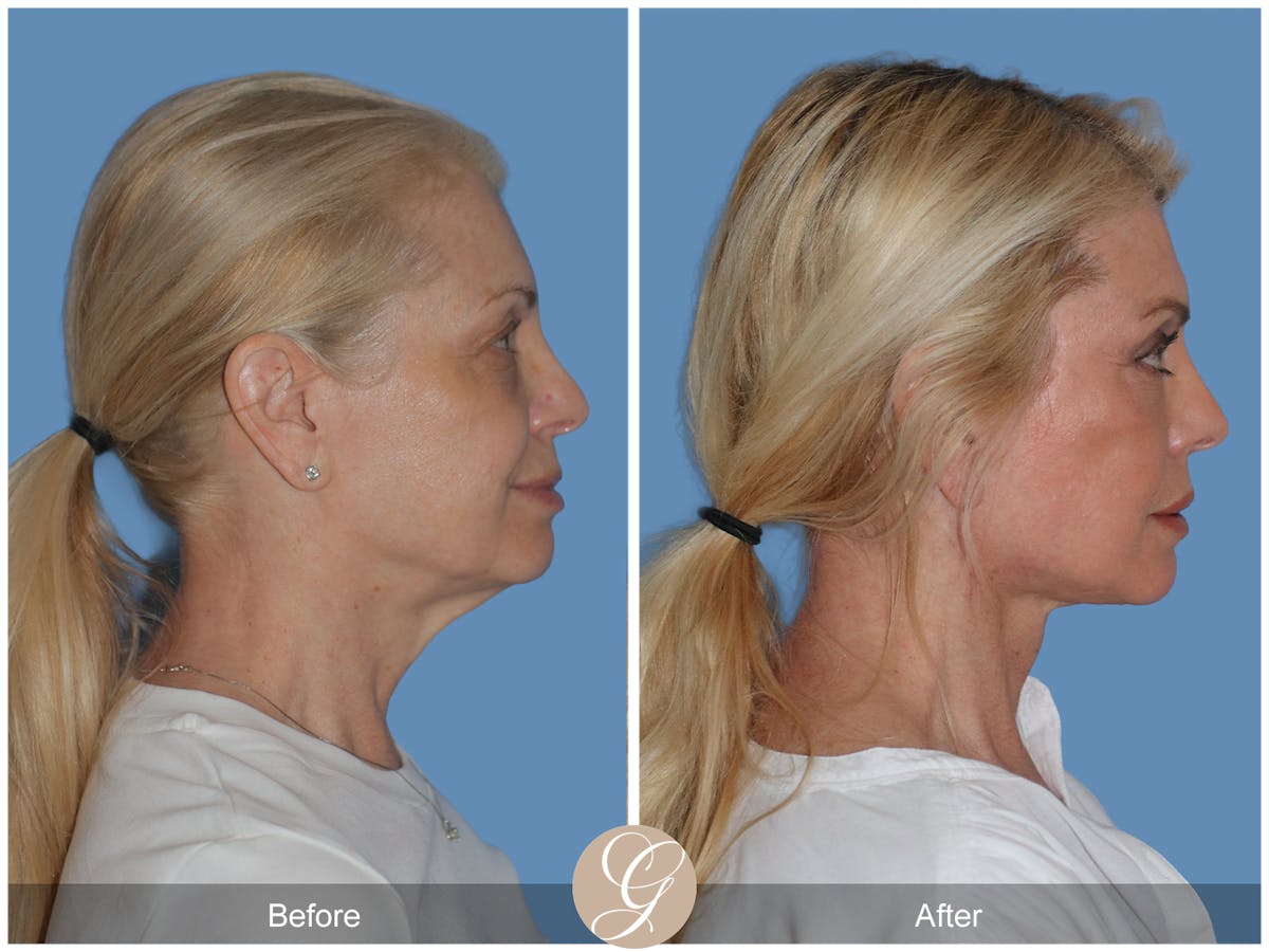 Preservation Facelift Before & After Gallery - Patient 306280 - Image 4