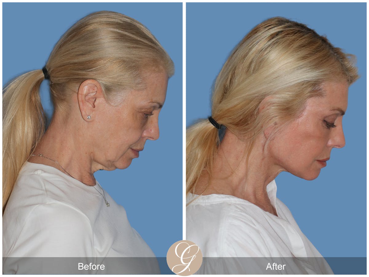 Preservation Facelift Before & After Gallery - Patient 306280 - Image 5