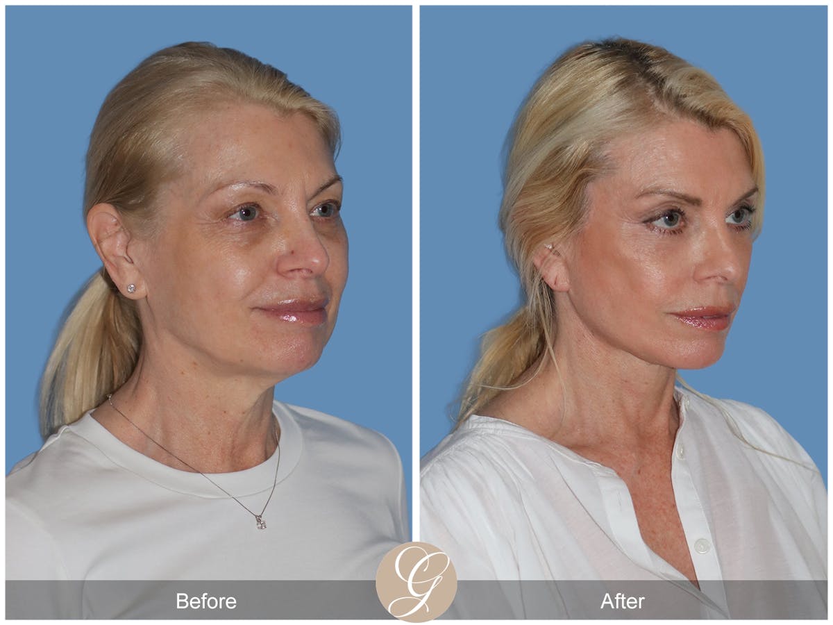 Preservation Facelift Before & After Gallery - Patient 306280 - Image 3