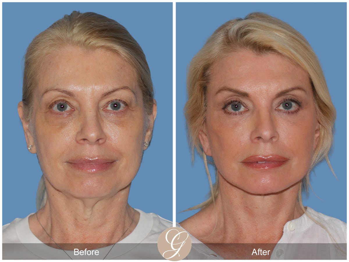 Preservation Facelift Before & After Gallery - Patient 306280 - Image 1