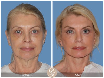Preservation Facelift Before & After Gallery - Patient 306280 - Image 1