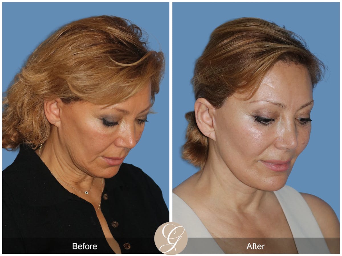 Preservation Facelift Before & After Gallery - Patient 303430 - Image 3