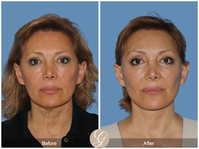 Preservation Facelift Before & After Gallery - Patient 303430 - Image 1