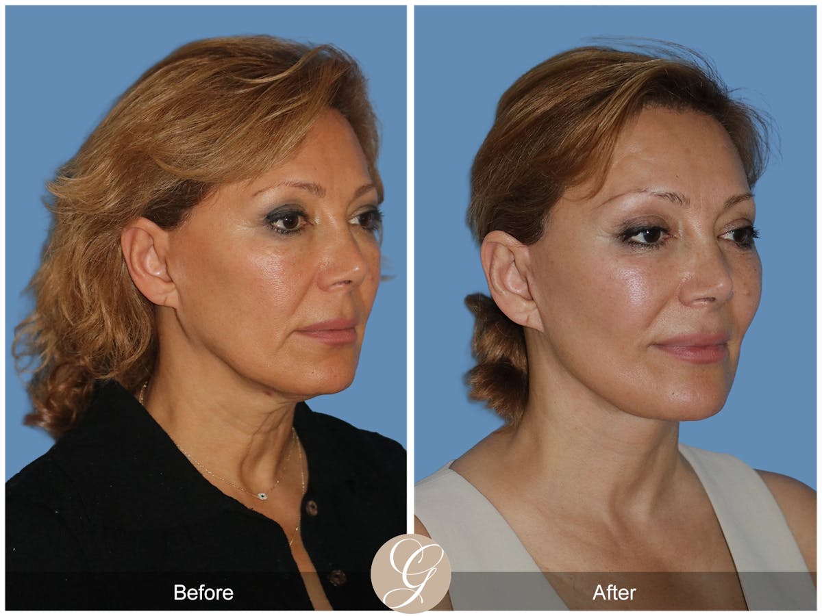 Preservation Facelift Before & After Gallery - Patient 303430 - Image 4