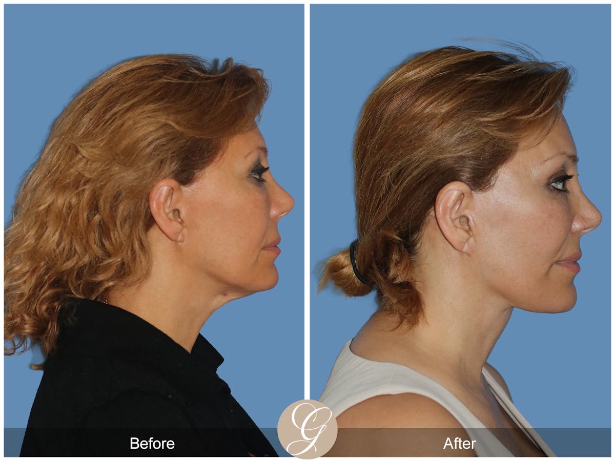 Preservation Facelift Before & After Gallery - Patient 303430 - Image 5