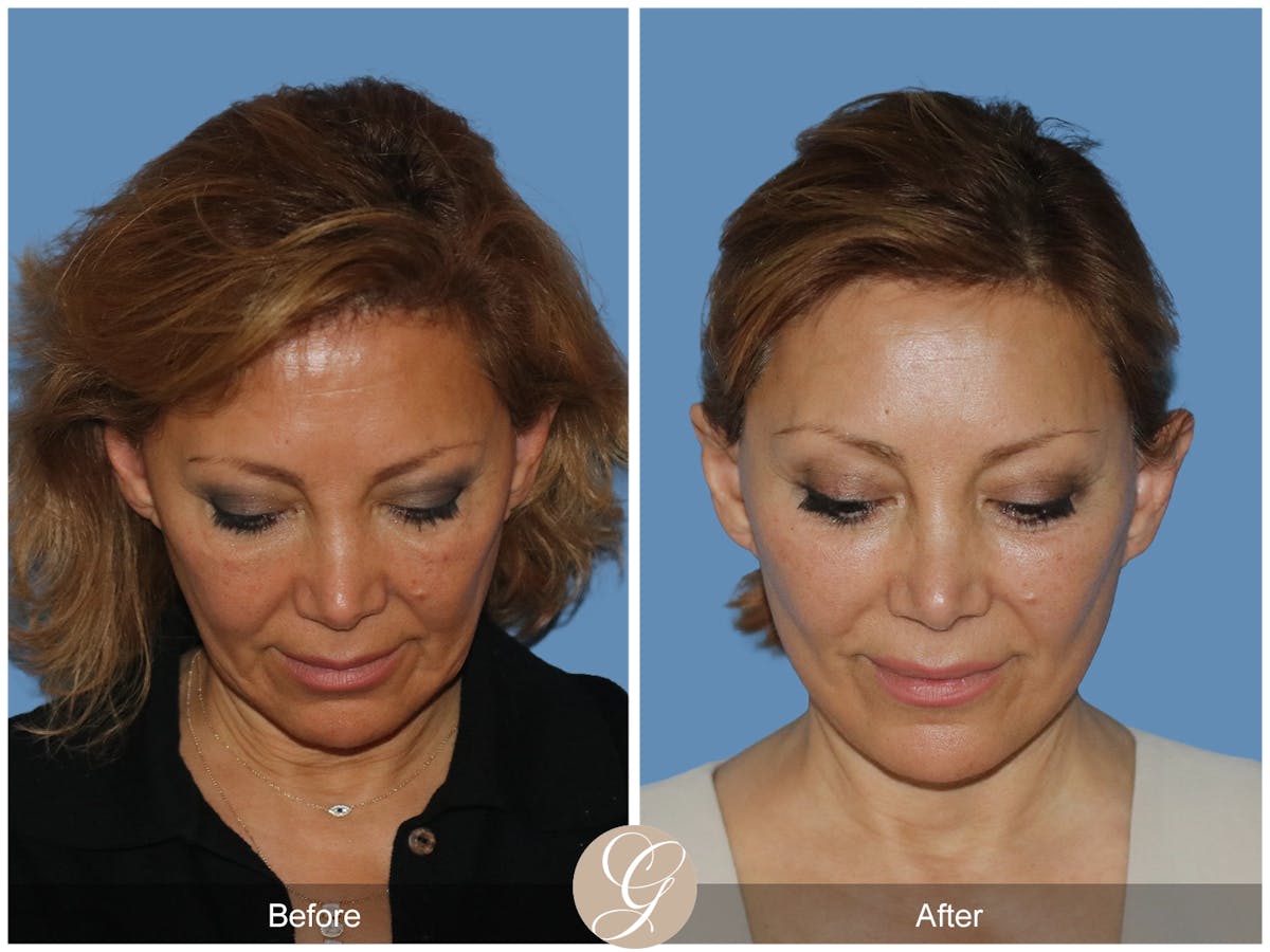 Preservation Facelift Before & After Gallery - Patient 303430 - Image 2