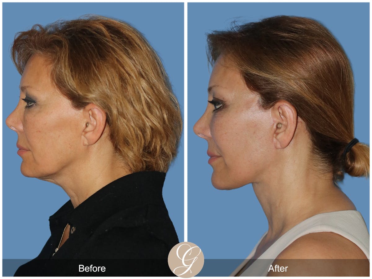 Preservation Facelift Before & After Gallery - Patient 303430 - Image 7