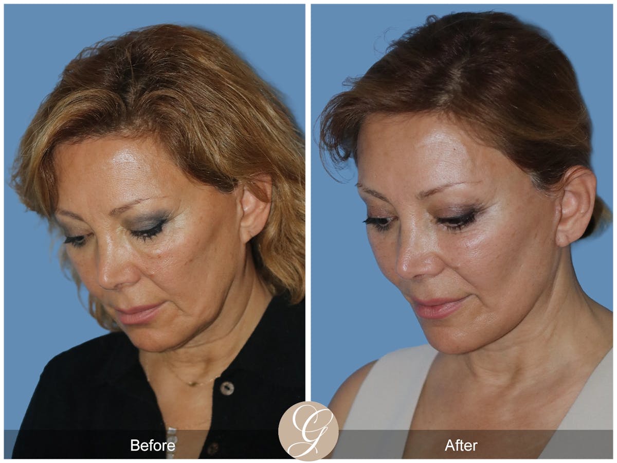Preservation Facelift Before & After Gallery - Patient 303430 - Image 6