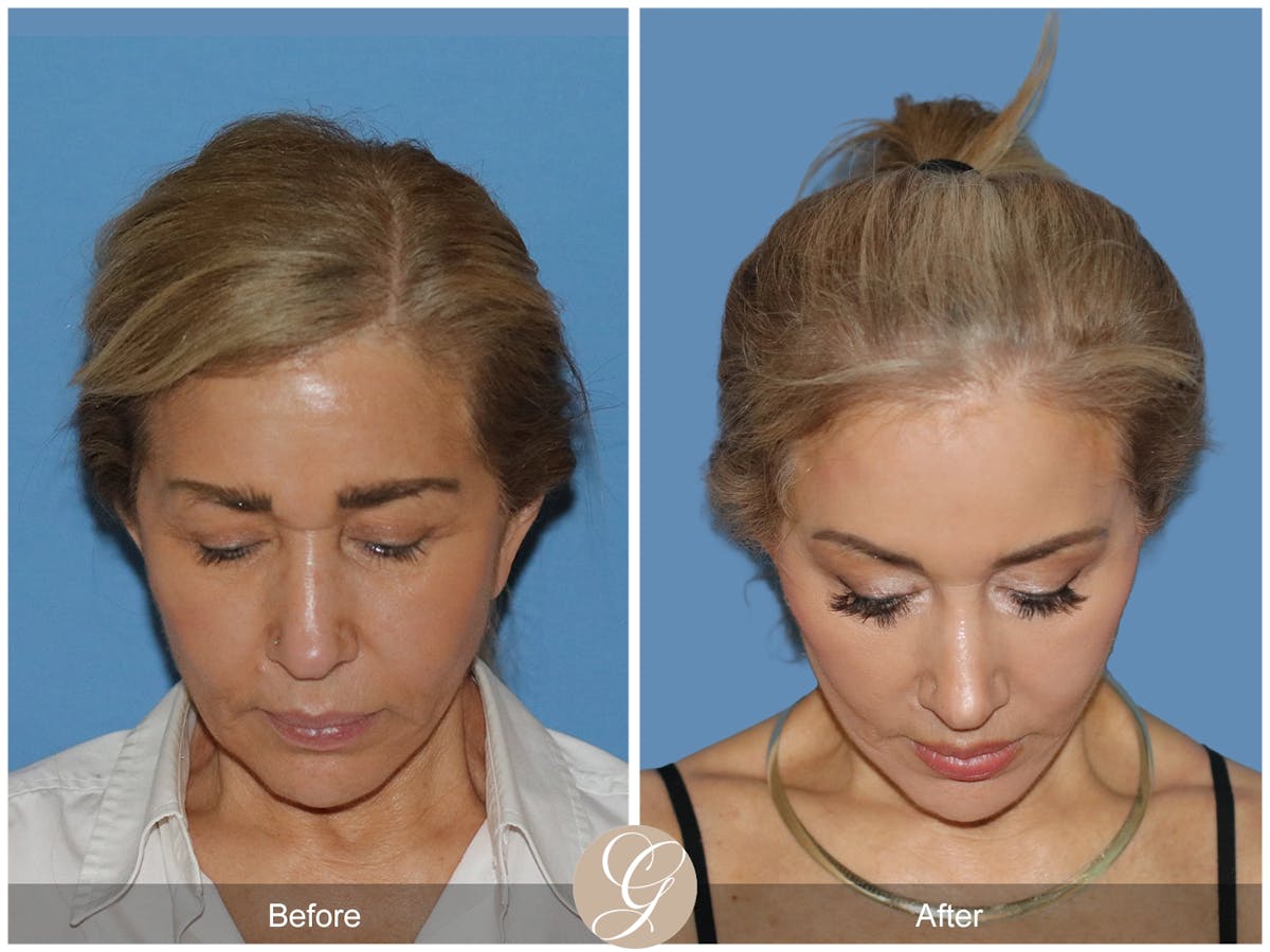 Preservation Facelift Before & After Gallery - Patient 795176 - Image 2