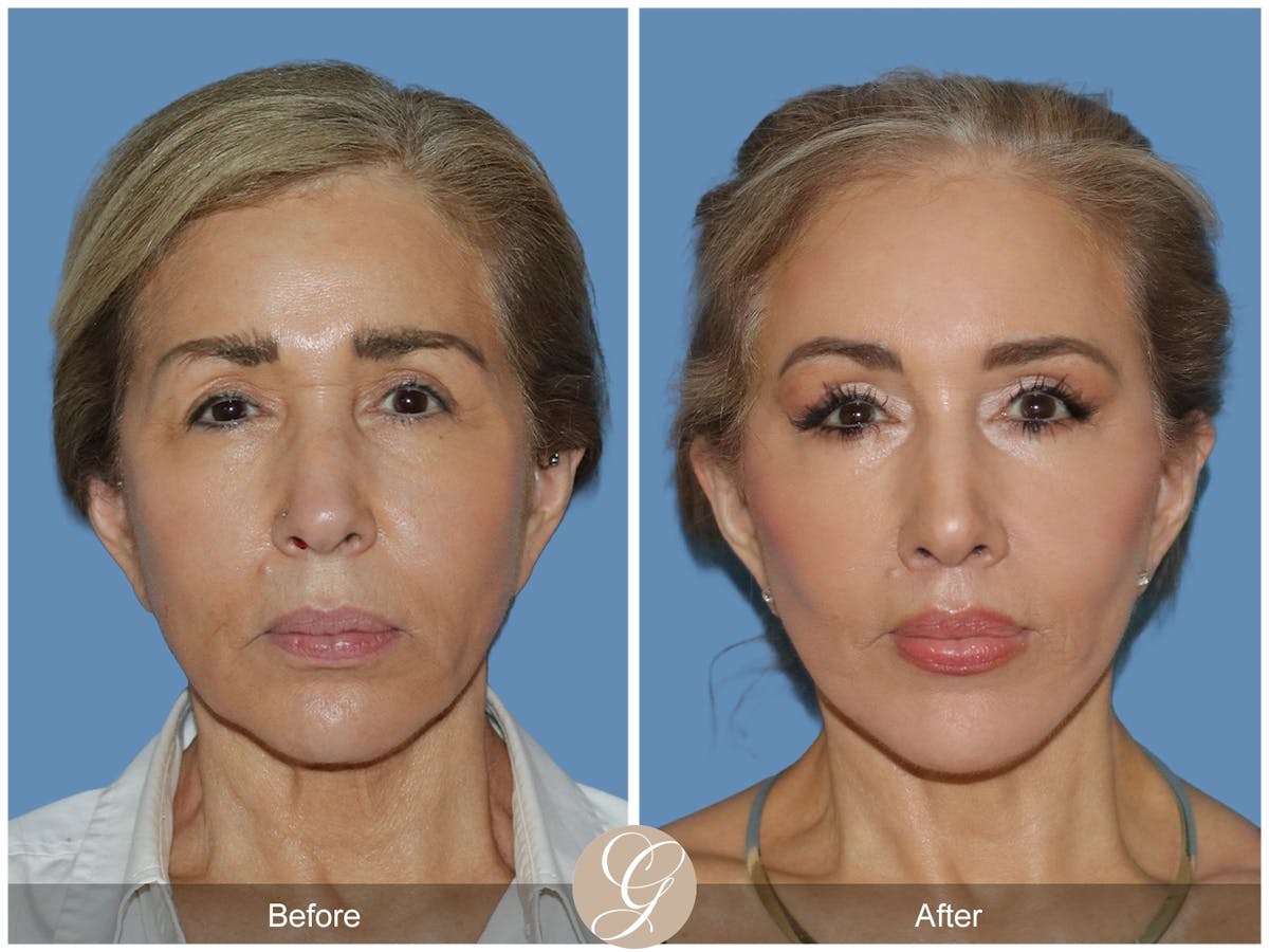Preservation Facelift Before & After Gallery - Patient 795176 - Image 1
