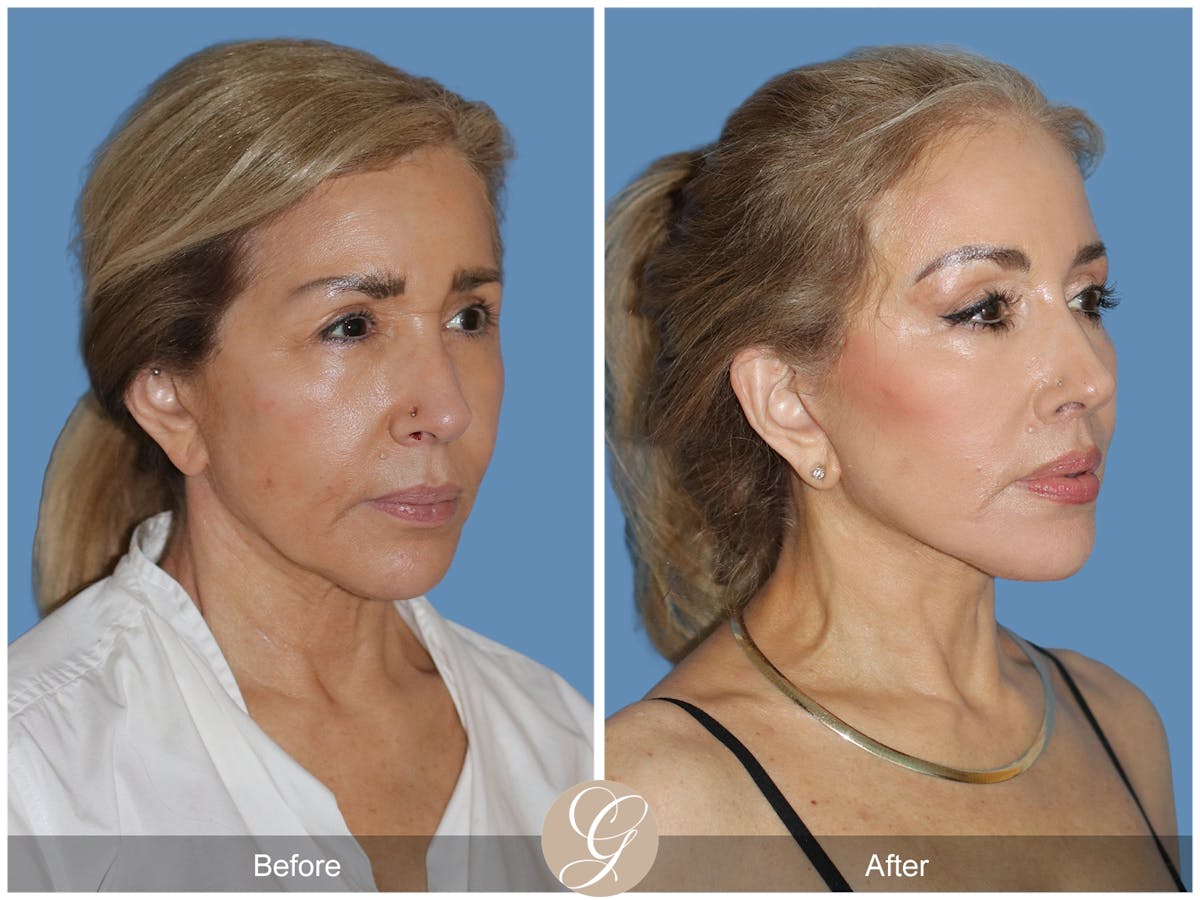 Preservation Facelift Before & After Gallery - Patient 795176 - Image 3