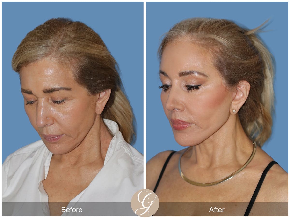 Preservation Facelift Before & After Gallery - Patient 795176 - Image 4