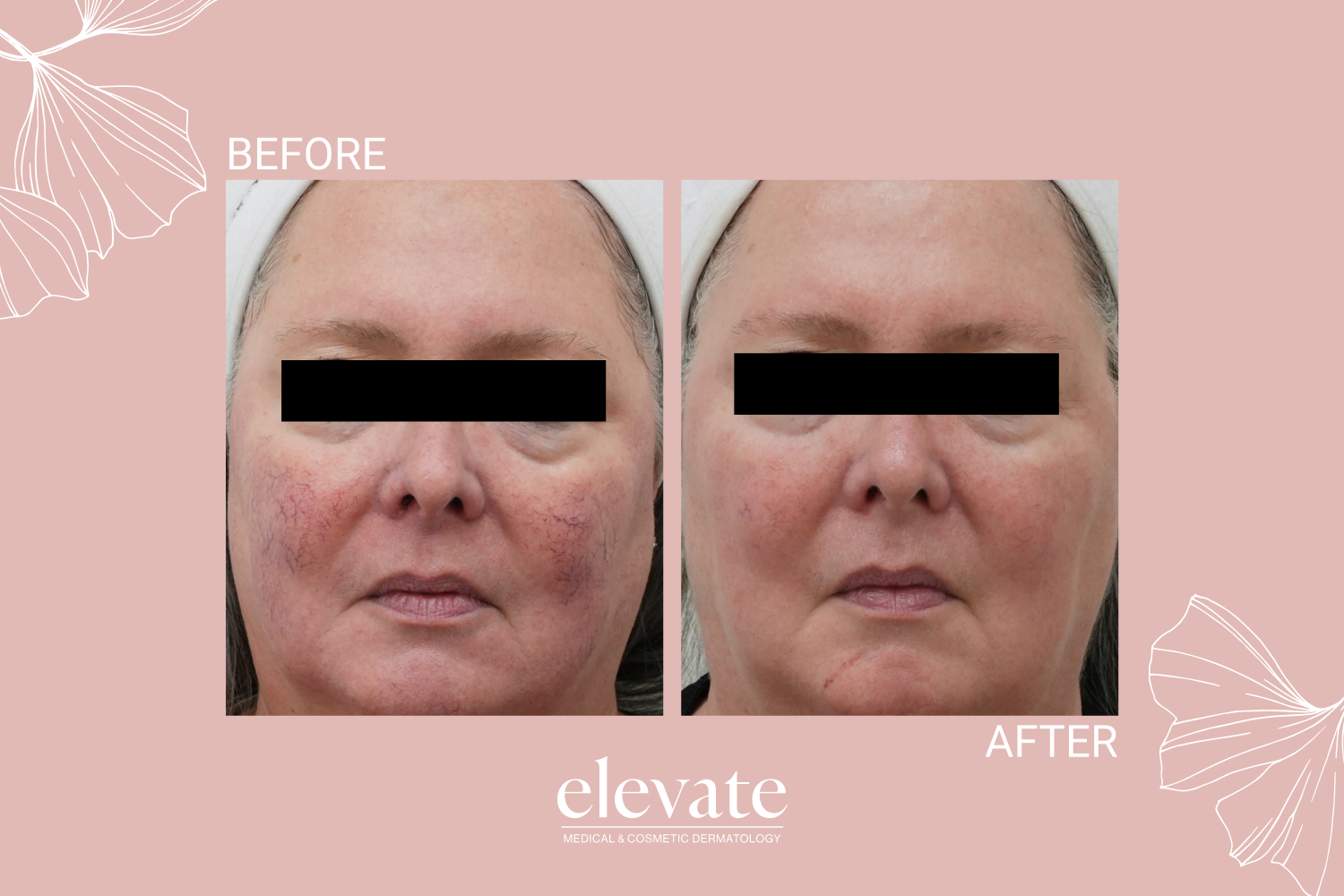 Before and after rosacea treatment using a series of 2D treatments combining Laser Genesis and IPL.