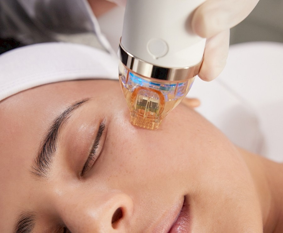 Secret PRO RF microneedling treatment for acne scars
