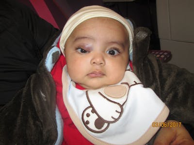 Capillary Hemangioma Before & After Gallery - Patient 206267 - Image 1