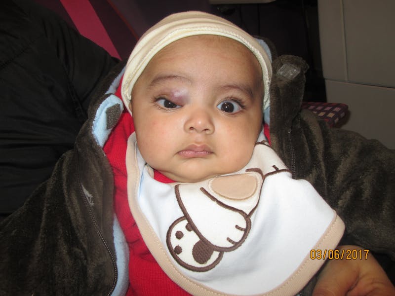 Capillary Hemangioma Before & After Gallery - Patient 206267 - Image 1