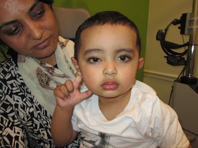 Capillary Hemangioma Before & After Gallery - Patient 206267 - Image 2