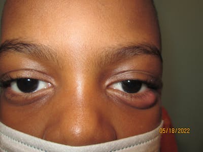 Chalazion Before & After Gallery - Patient 363401 - Image 1