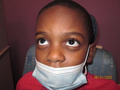 Chalazion Before & After Gallery - Patient 363401 - Image 2