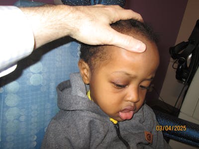 Dermoid Before & After Gallery - Patient 346269 - Image 2