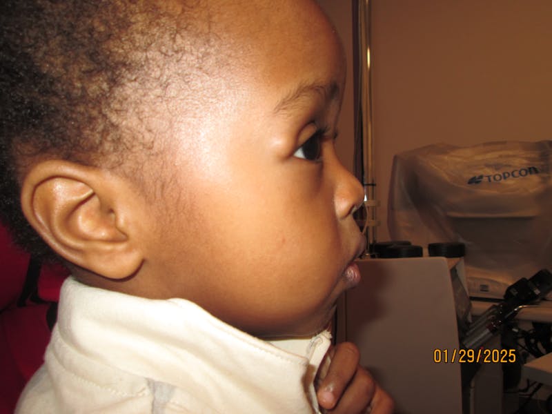 Dermoid Before & After Gallery - Patient 346269 - Image 3