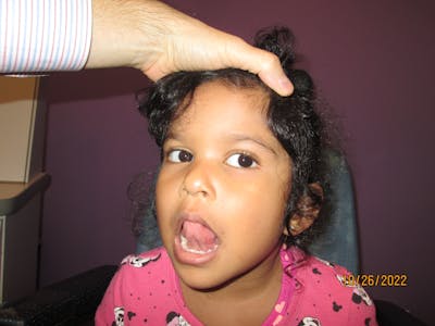 Dermoid Before & After Gallery - Patient 240374 - Image 2