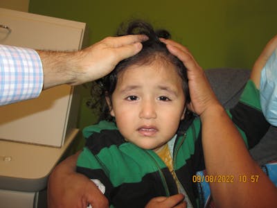 Dermoid Before & After Gallery - Patient 891829 - Image 1