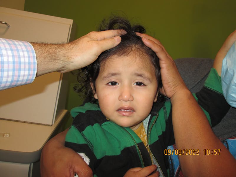 Dermoid Before & After Gallery - Patient 891829 - Image 1