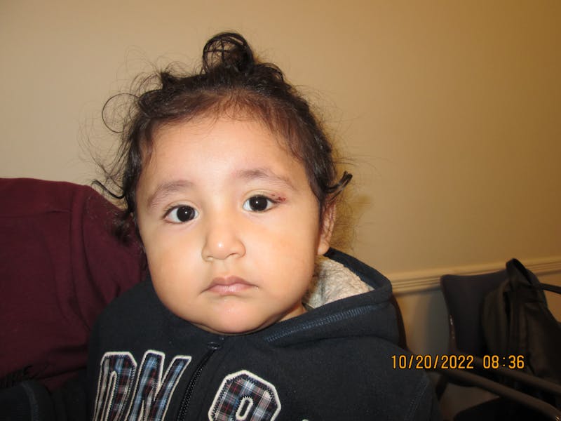 Dermoid Before & After Gallery - Patient 891829 - Image 2