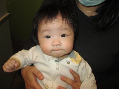 Dermoid Before & After Gallery - Patient 171754 - Image 1