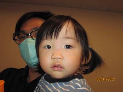 Dermoid Before & After Gallery - Patient 171754 - Image 2