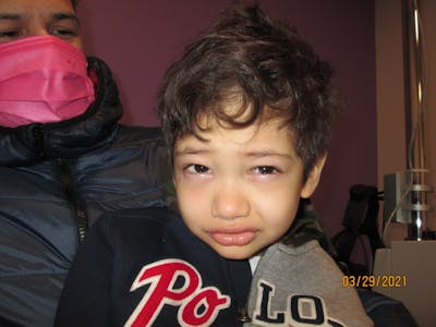 Epiblepharon Before & After Gallery - Patient 283693 - Image 1