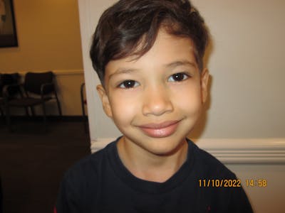 Epiblepharon Before & After Gallery - Patient 283693 - Image 2