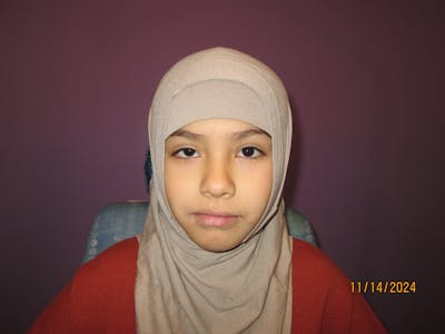 Ptosis Before & After Gallery - Patient 426278 - Image 1
