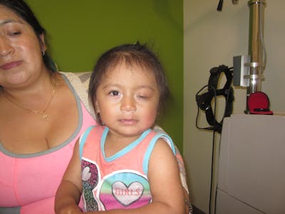 Complex Strabismus Before & After Gallery - Patient 402010 - Image 1