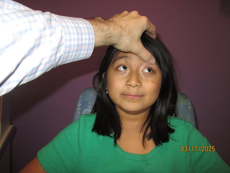 Complex Strabismus Before & After Gallery - Patient 402010 - Image 4