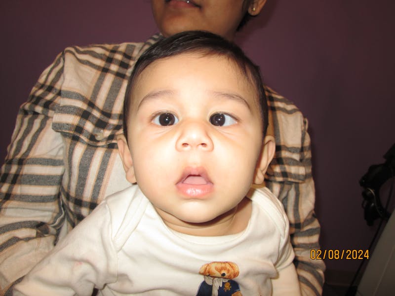 Esotropia Before & After Gallery - Patient 343873 - Image 1