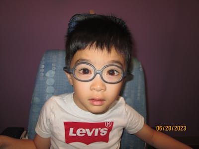 Esotropia Before & After Gallery - Patient 975150 - Image 2