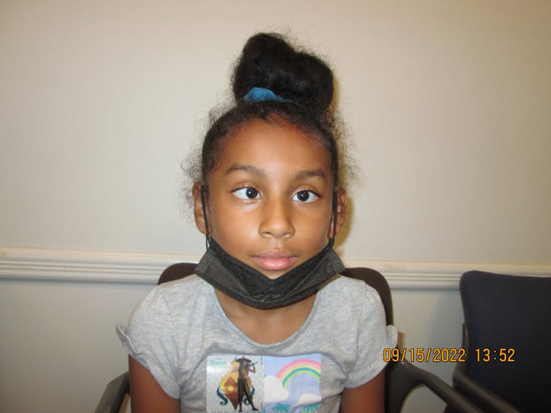 Esotropia Before & After Gallery - Patient 532350 - Image 1
