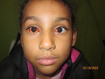 Esotropia Before & After Gallery - Patient 532350 - Image 2