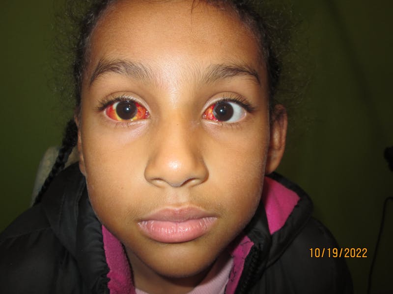 Esotropia Before & After Gallery - Patient 532350 - Image 2
