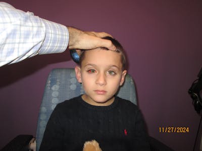 Exotropia Before & After Gallery - Patient 393784 - Image 2