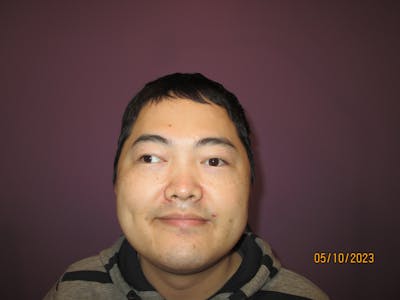 Exotropia Before & After Gallery - Patient 171446 - Image 1