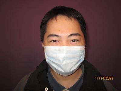 Exotropia Before & After Gallery - Patient 171446 - Image 2
